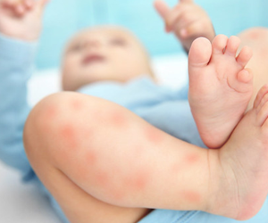 Baby with a rash